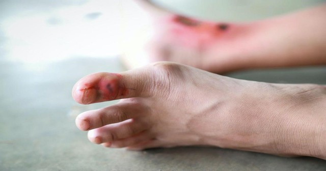 Bệnh nhân nam suýt mất mạng c…